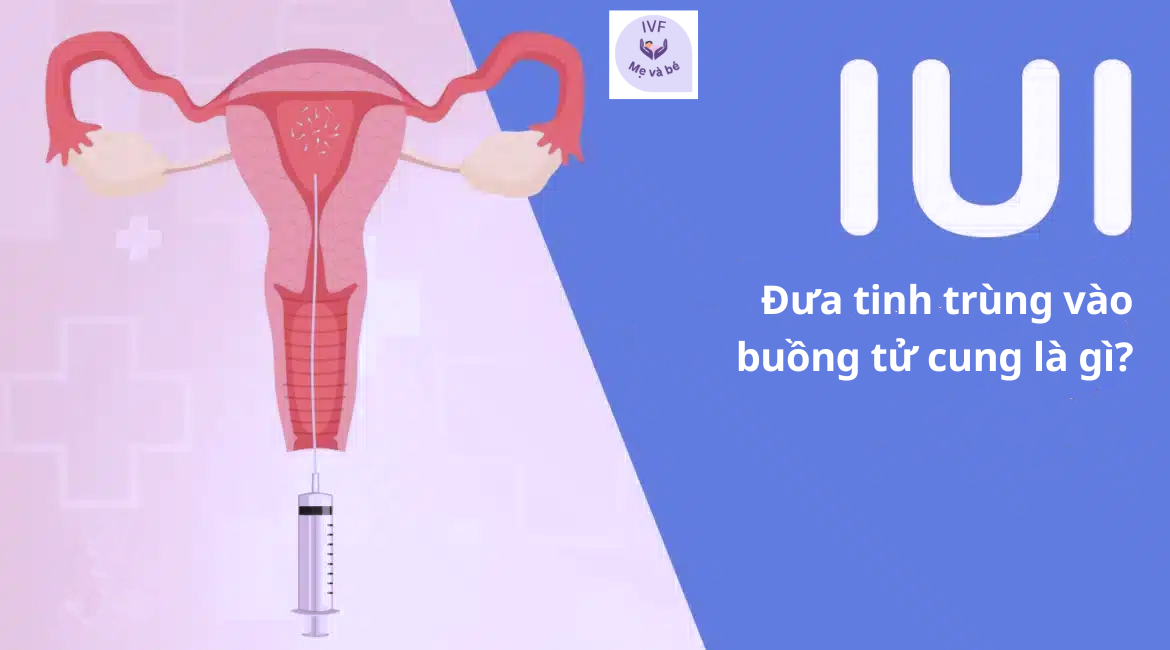 Đưa tinh trùng vào buồng tử cung (Thụ tinh trong tử cung: IUI)